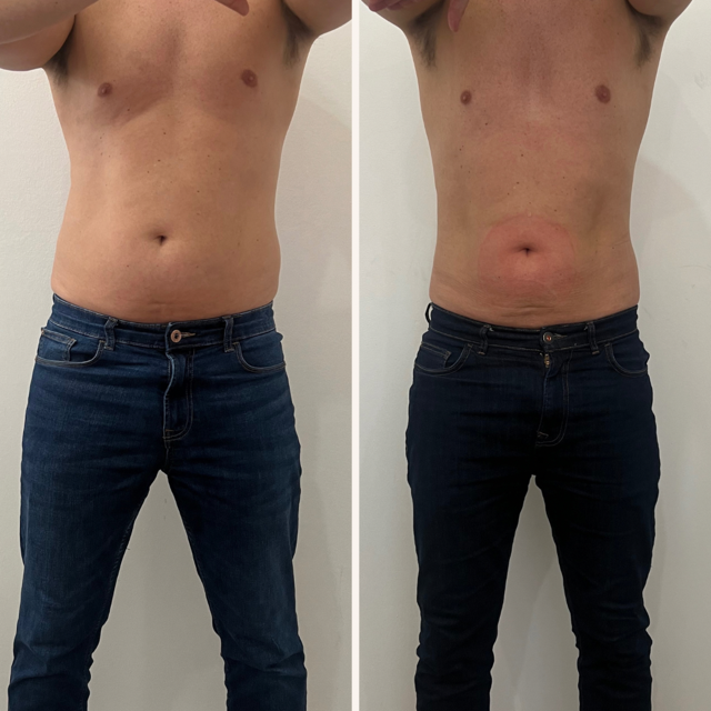 EMsculpt Neo treatment for Jason Sparks from Marylebone, London